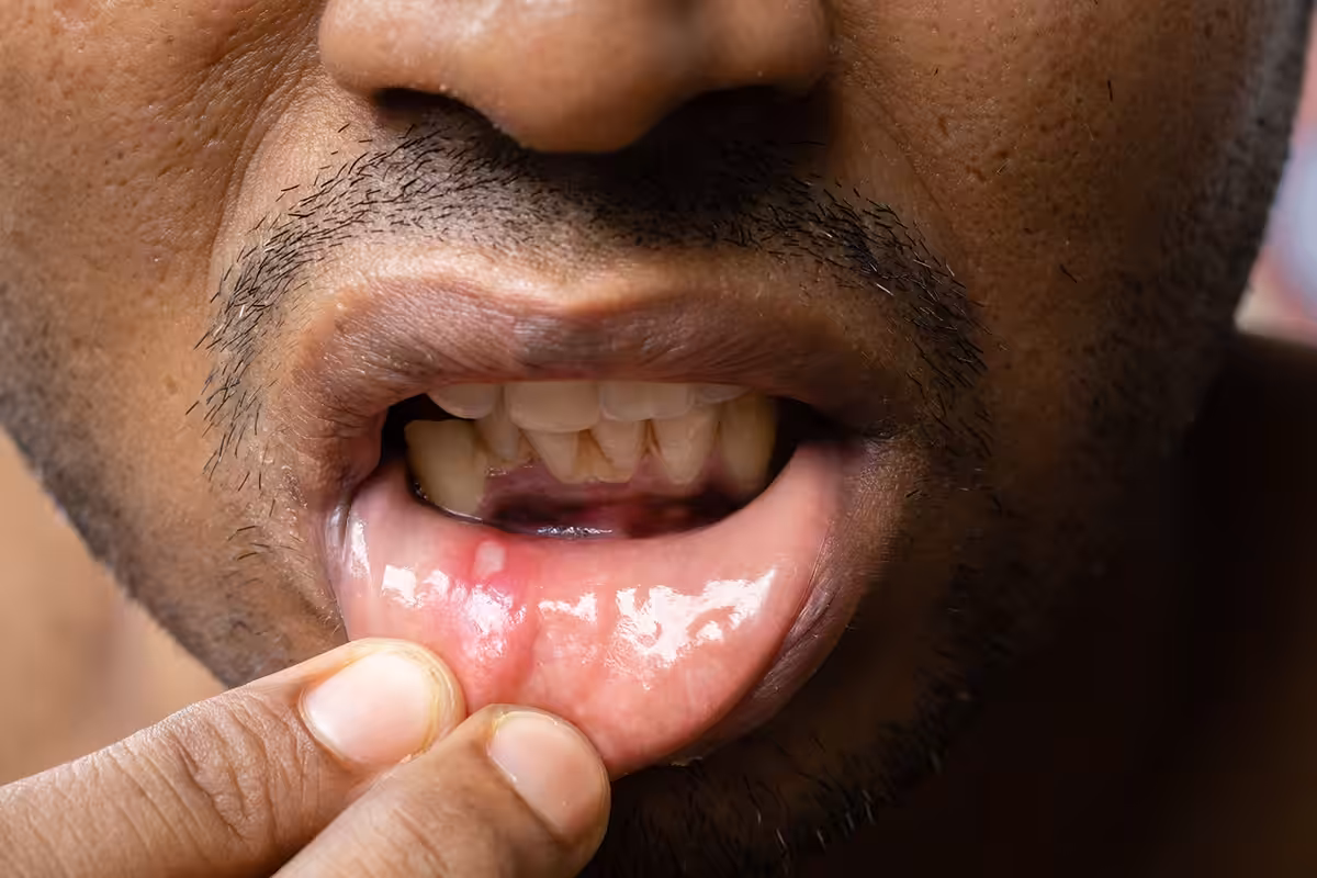Close up of a canker sore on the inside of a patient's lower lip