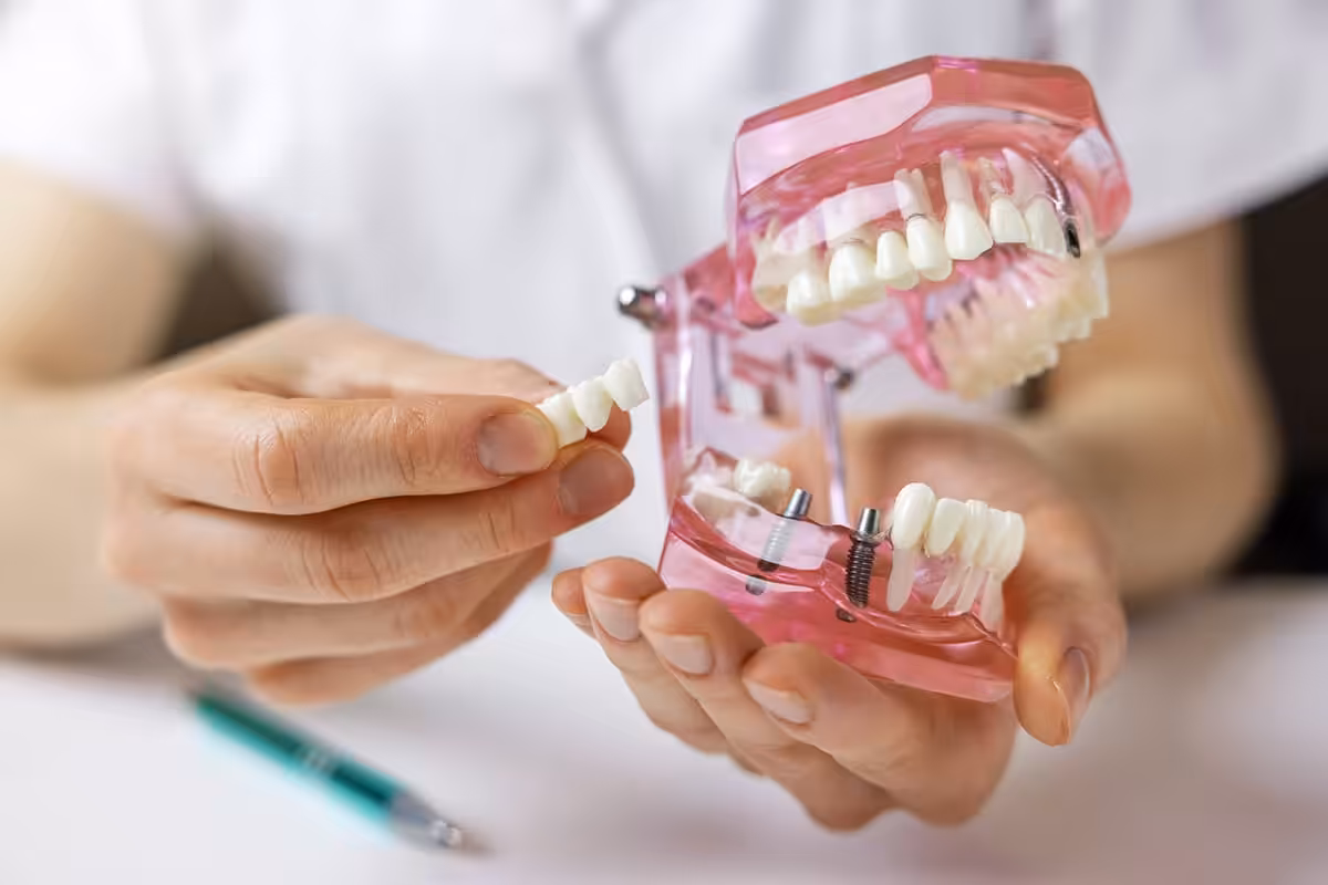 Dentist holding a dental implant and bridge model to compare tooth replacement options