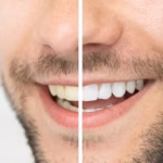 Before and after teeth whitening comparison of a patient's smile