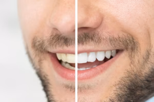 Before and after teeth whitening comparison of a patient's smile