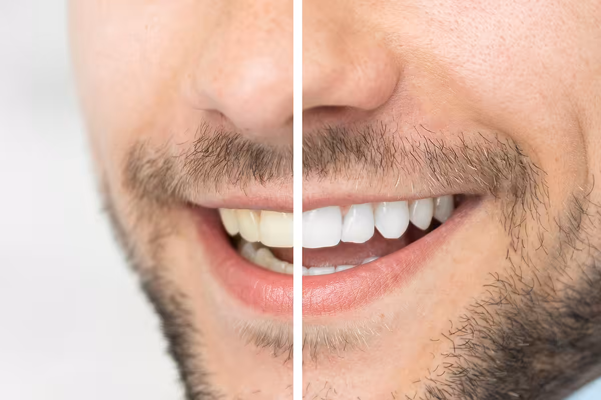 Before and after teeth whitening comparison of a patient's smile