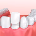 Illustration of a porcelain veneer being placed over a front tooth