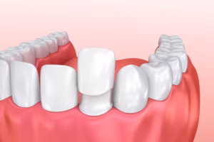 Illustration of a porcelain veneer being placed over a front tooth