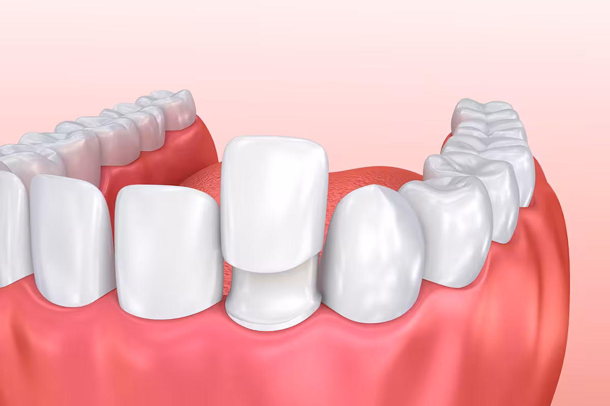 Illustration of a porcelain veneer being placed over a front tooth
