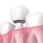 Illustration of a dental crown being placed over a prepared tooth