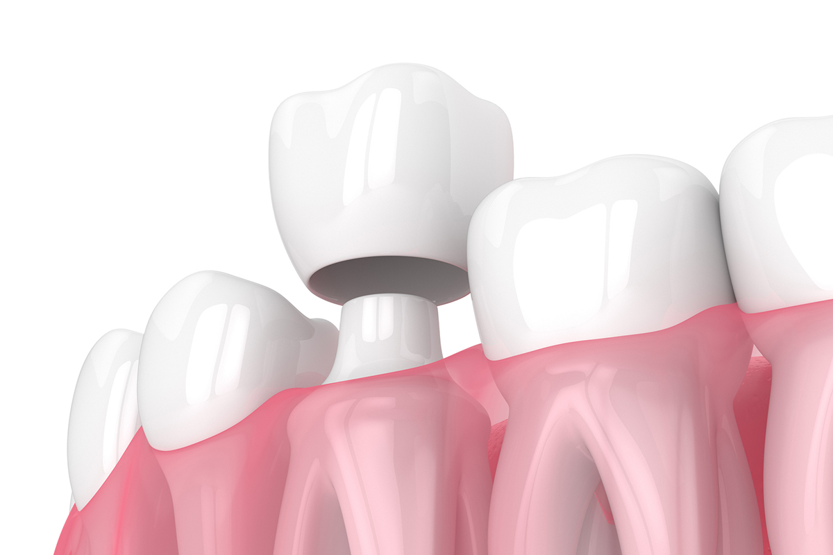 Illustration of a dental crown being placed over a prepared tooth